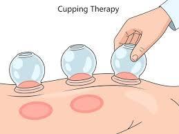 Les ventouses sèches (cupping therapy)